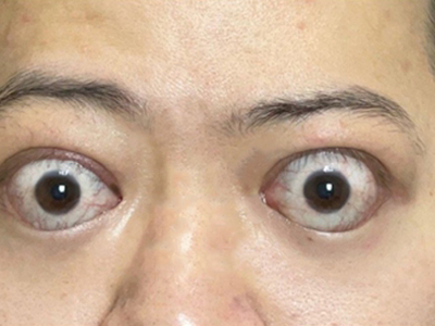甲状腺相关眼病眼睛圆瞪眼眶胀痛图