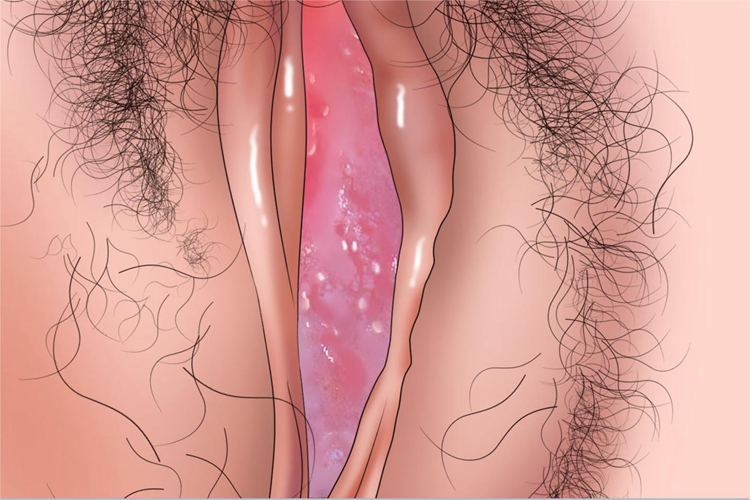 外阴鳞状上皮内病变溃疡图