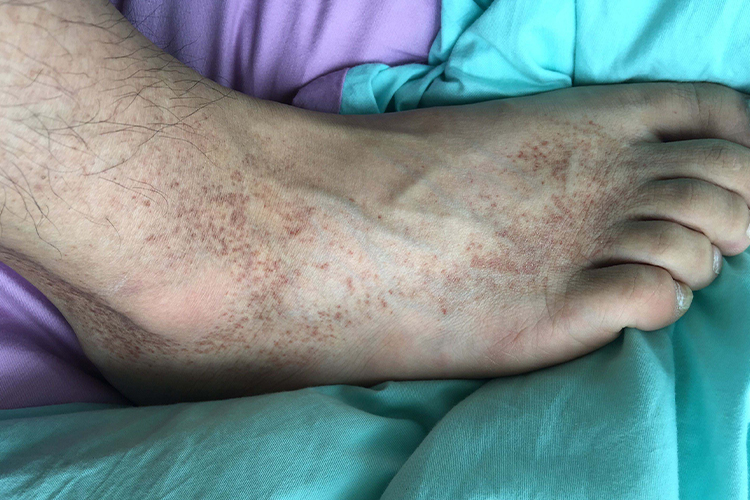 过敏性皮炎脚部黑色素沉着图