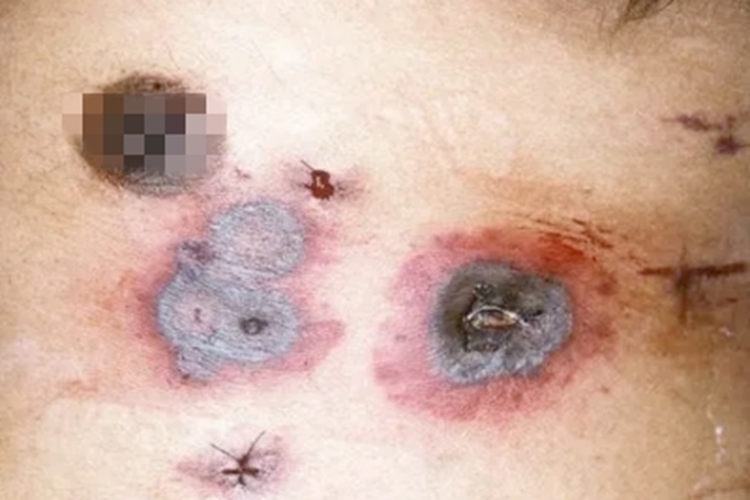 皮肤型毛霉病症状图