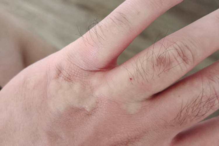 日光性荨麻疹手背症状图