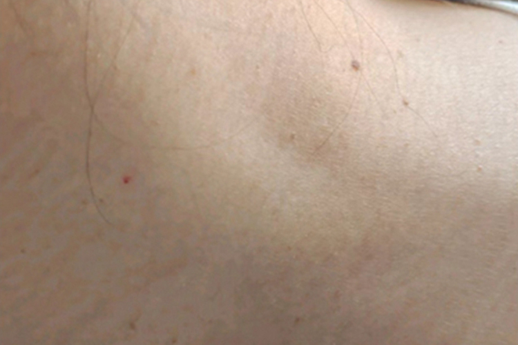 扁平疣脖子出现褐色小丘疹图