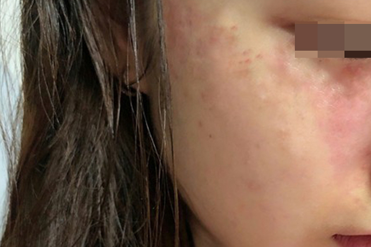 585激光后紫癜变浅图 585激光后紫癜变浅图