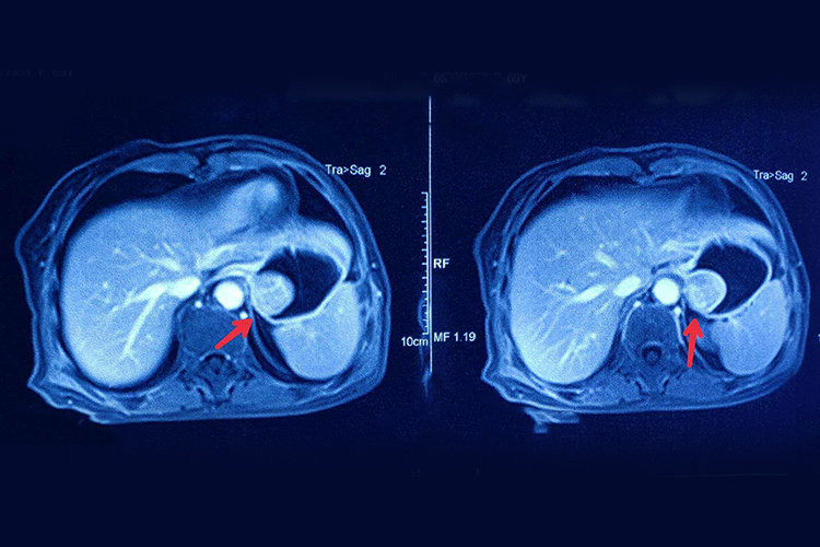 胃外壁平滑肌瘤CT图