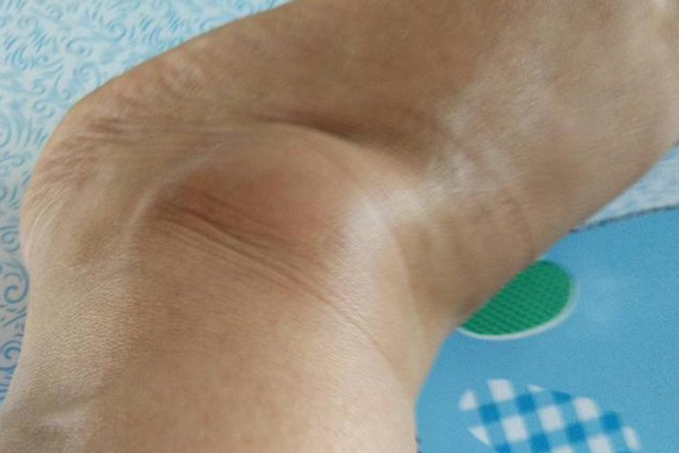 脚踝腱鞘囊肿图 脚踝腱鞘囊肿图