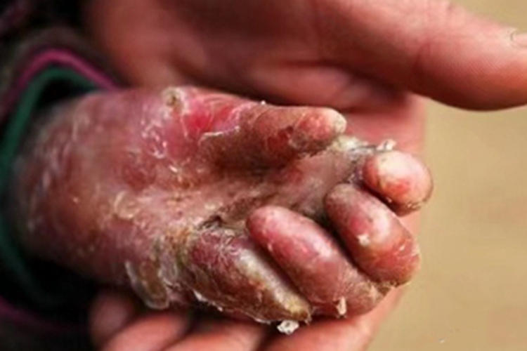 大疱性表皮松解症手部脱屑图 大疱性表皮松解症手部脱屑图