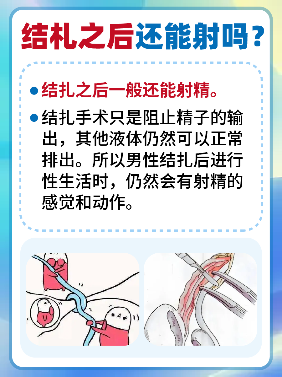 结扎后是否能射精,医生解读真相