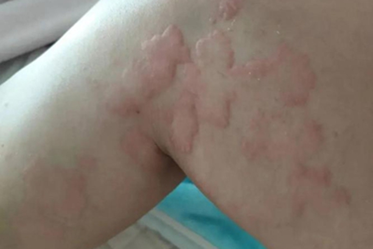 脓毒败血症疹大腿皮肤凹凸不平图