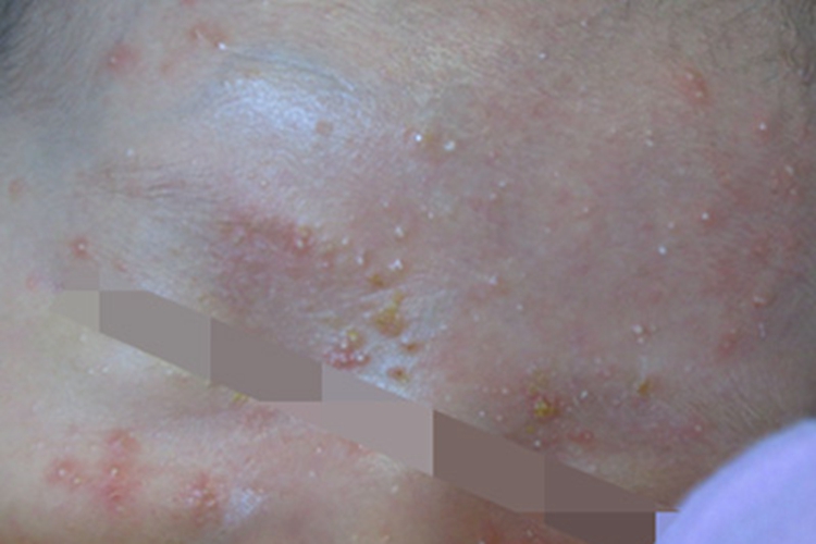 渗出型婴儿湿疹面部小疙瘩图