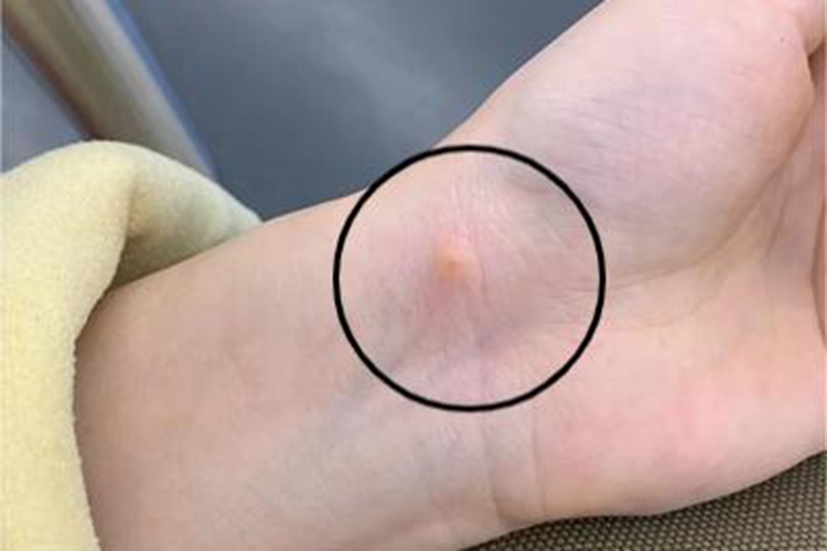 虫咬皮炎手腕小红疙瘩图