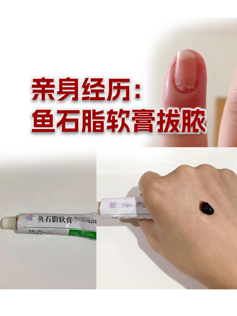 亲身经历：鱼石脂软膏拔脓