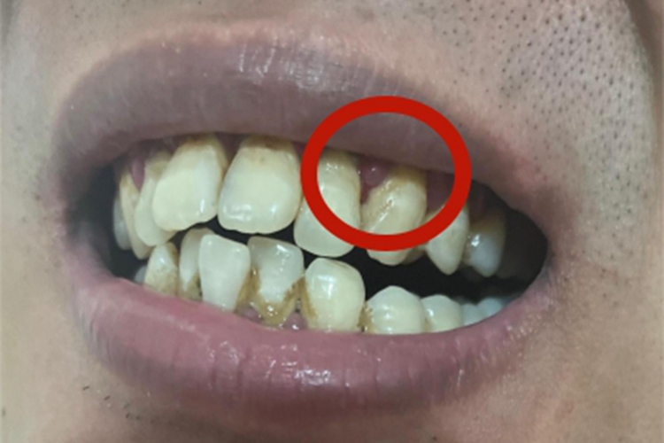 急性浆液性根尖周炎牙龈肿图 急性浆液性根尖周炎牙龈肿图