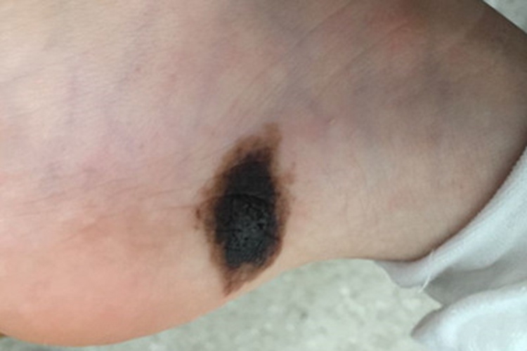 皮内痣脚部斑图 皮内痣脚部斑图