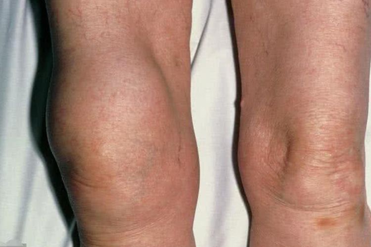 滑膜炎右膝盖肿胀图 滑膜炎右膝盖肿胀图