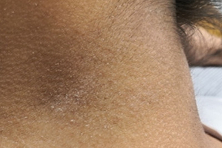 面颈部毛囊性红斑黑变病脱屑图