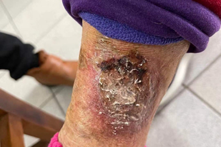 淤积性皮炎小腿结痂图