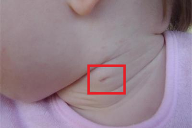 第二鳃裂瘘管颈部坑图 第二鳃裂瘘管颈部坑图