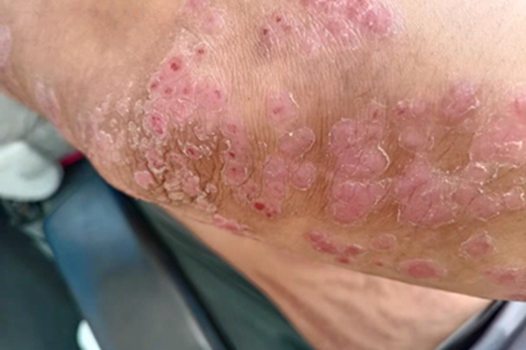 慢性湿疹肘部红色环形斑图