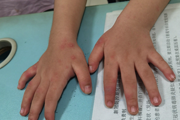 手足综合征手背丘疹图
