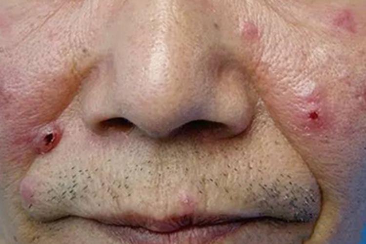 结节性梅毒疹面部症状图