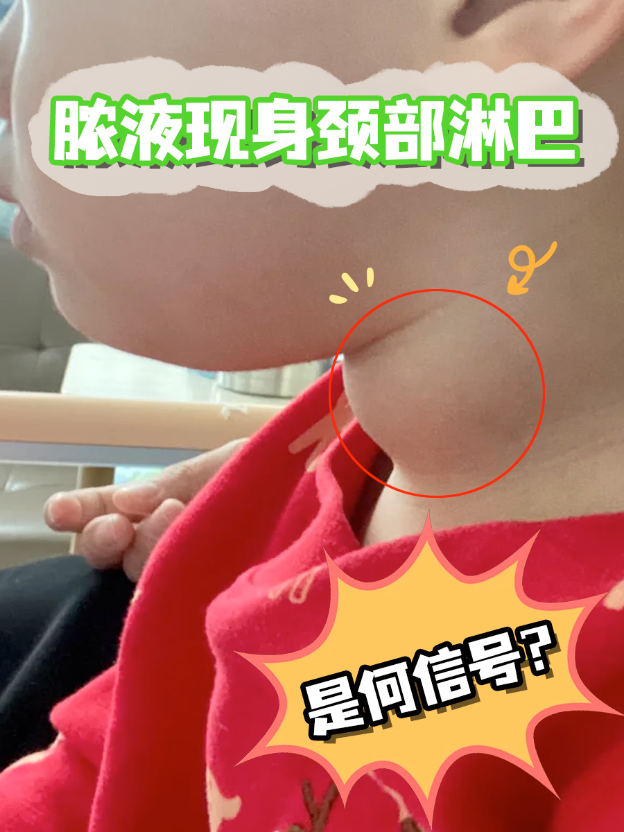 脓液现身颈部淋巴，是何信号？