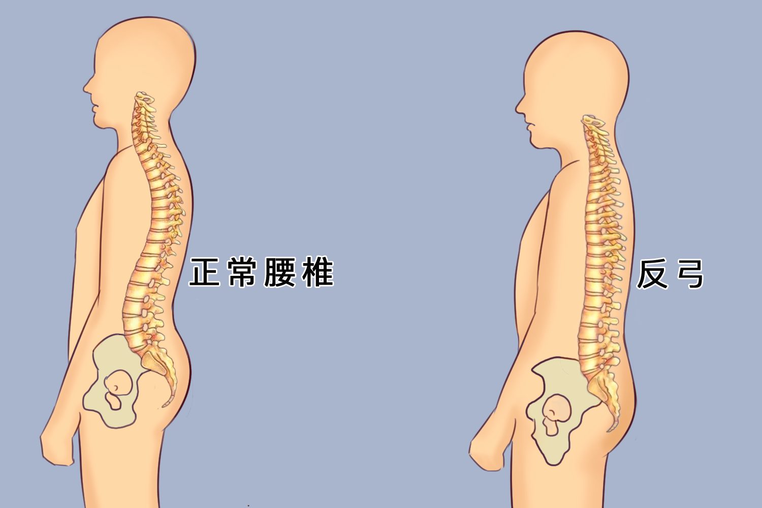 腰椎反弓图 腰椎反弓图
