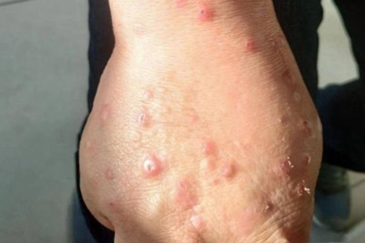 瘤型麻风手背结节图