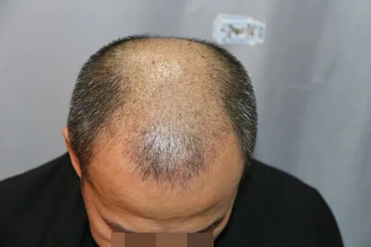 男性脂溢性脱发Ⅵ级图 男性脂溢性脱发Ⅵ级图