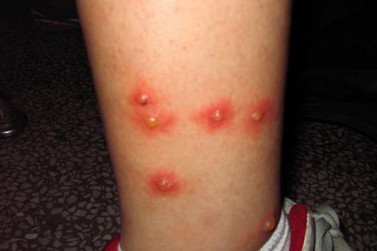 小腿突然长水疱很痒图片