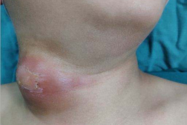 面颈部放线菌病颈部肿块脱皮图 面颈部放线菌病颈部肿块脱皮图