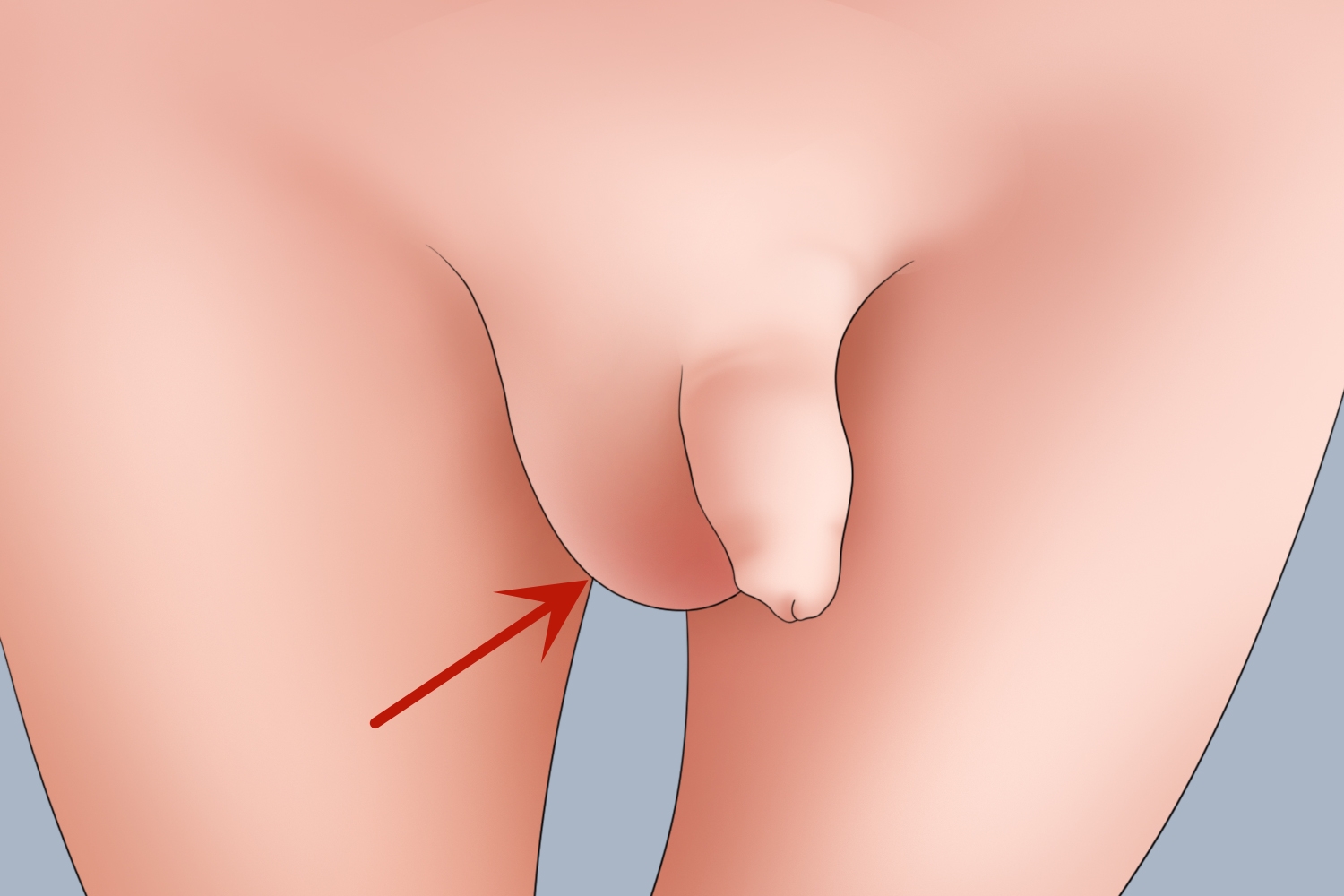 阴囊疝气症状图