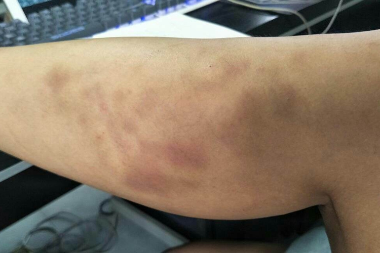 蚊子咬过后过敏性紫癜图