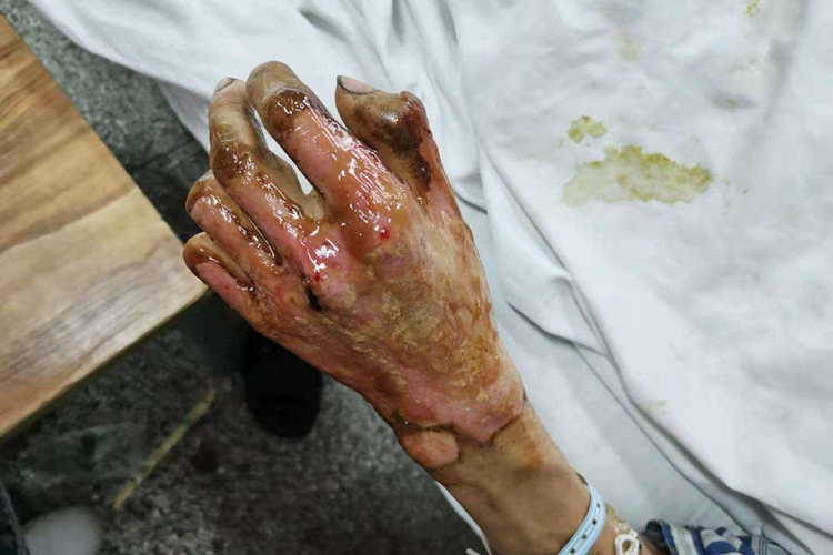 重度火疮体液渗出图 重度火疮体液渗出图