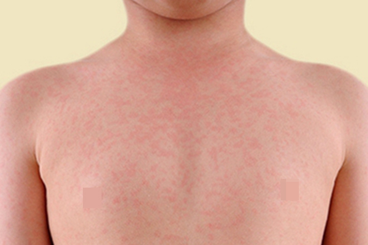 胆碱能性荨麻疹胸部丘疹图 胆碱能性荨麻疹胸部丘疹图