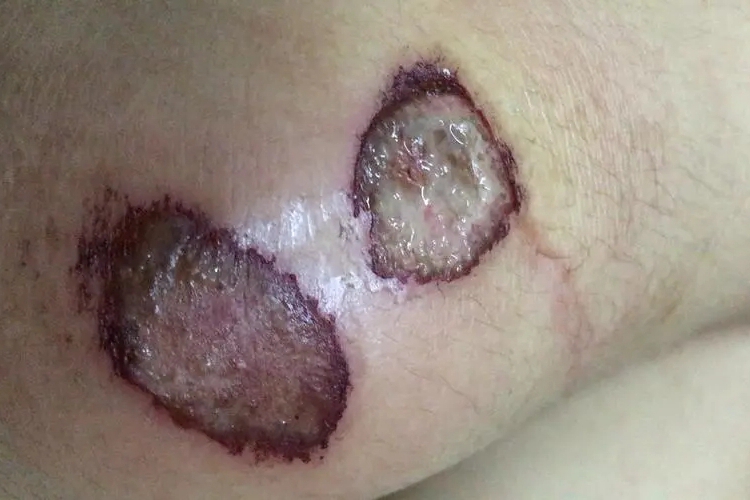 膝盖擦伤化脓图 膝盖擦伤化脓图