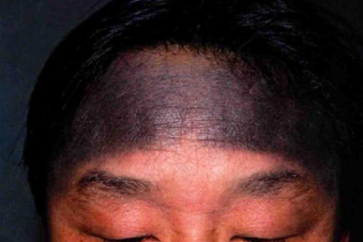 女子颜面黑变病皮肤发紫图 女子颜面黑变病皮肤发紫图