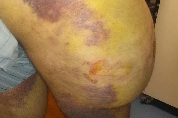 闭合性脱套伤图 闭合性脱套伤图