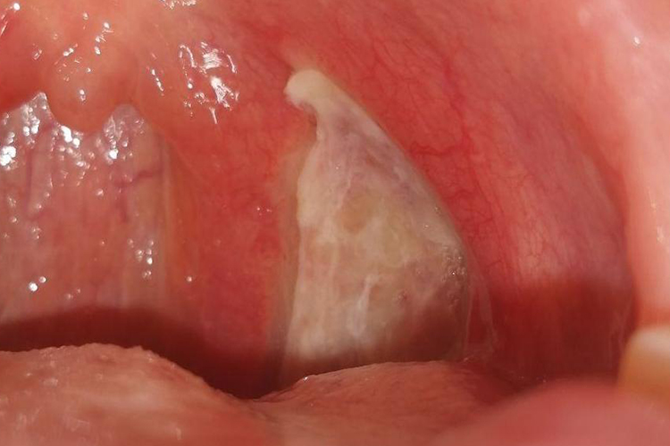 咽峡炎扁桃体一侧溃疡图 咽峡炎扁桃体一侧溃疡图