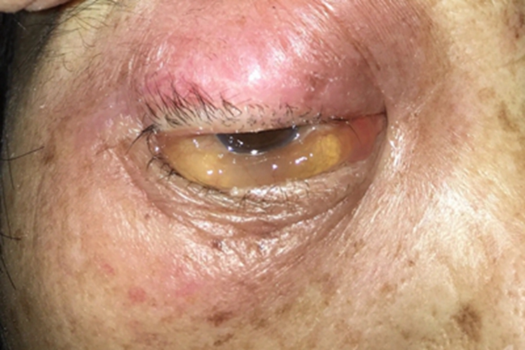 蜂窝织炎眼部肿图 蜂窝织炎眼部肿图