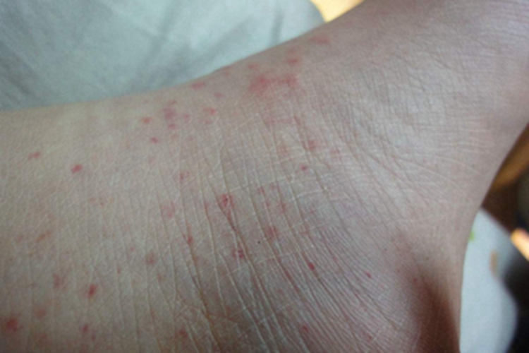 机械性紫癜脚背血点图