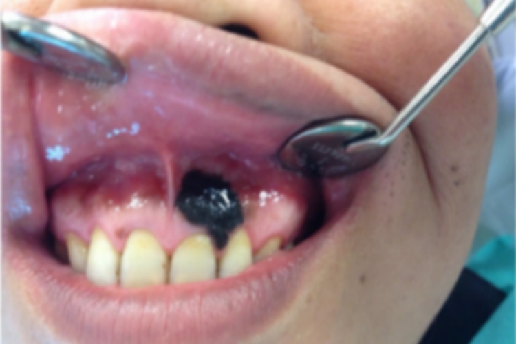 恶性黑色素瘤牙龈结节图