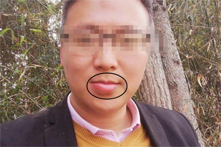 蜂蜇伤嘴唇肿图