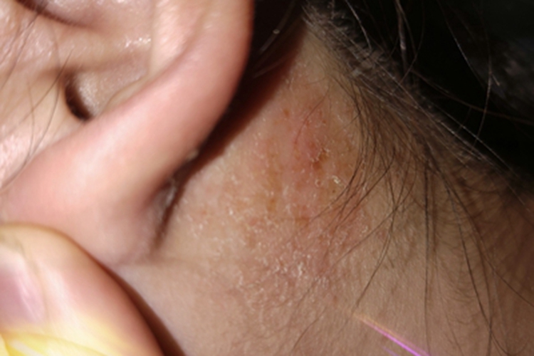 成人脂溢性皮炎耳后症状图 成人脂溢性皮炎耳后症状图