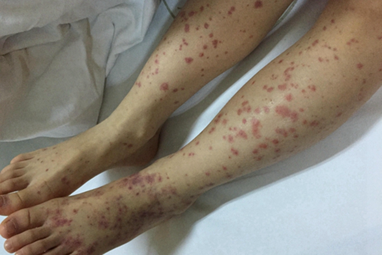 小儿过敏性紫癜小腿有红斑图