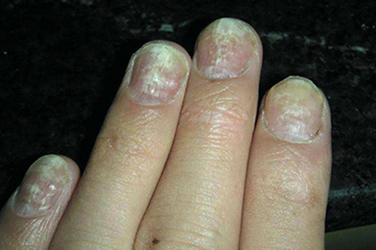 手指甲被真菌腐蚀图片图片