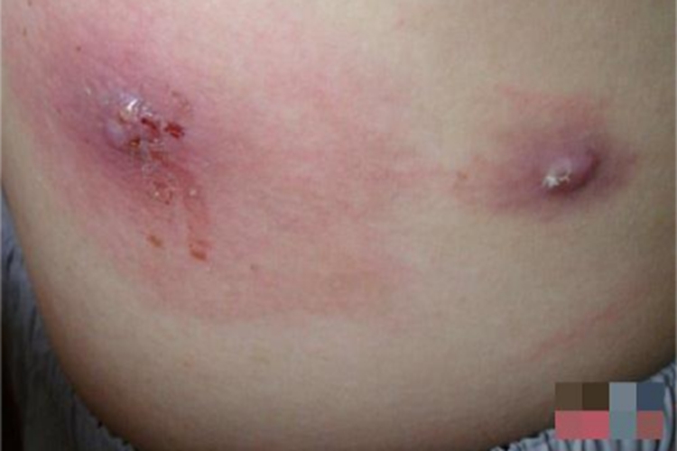 皮肤蝇蛆病症状图