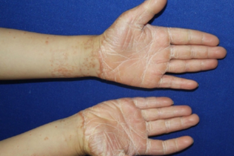 毛发红糠疹裂纹图