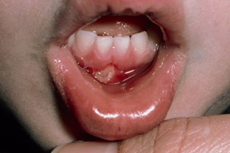 过敏性接触性口炎牙龈症状图 过敏性接触性口炎牙龈症状图