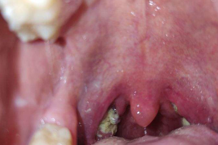 急性化脓性扁桃体炎图