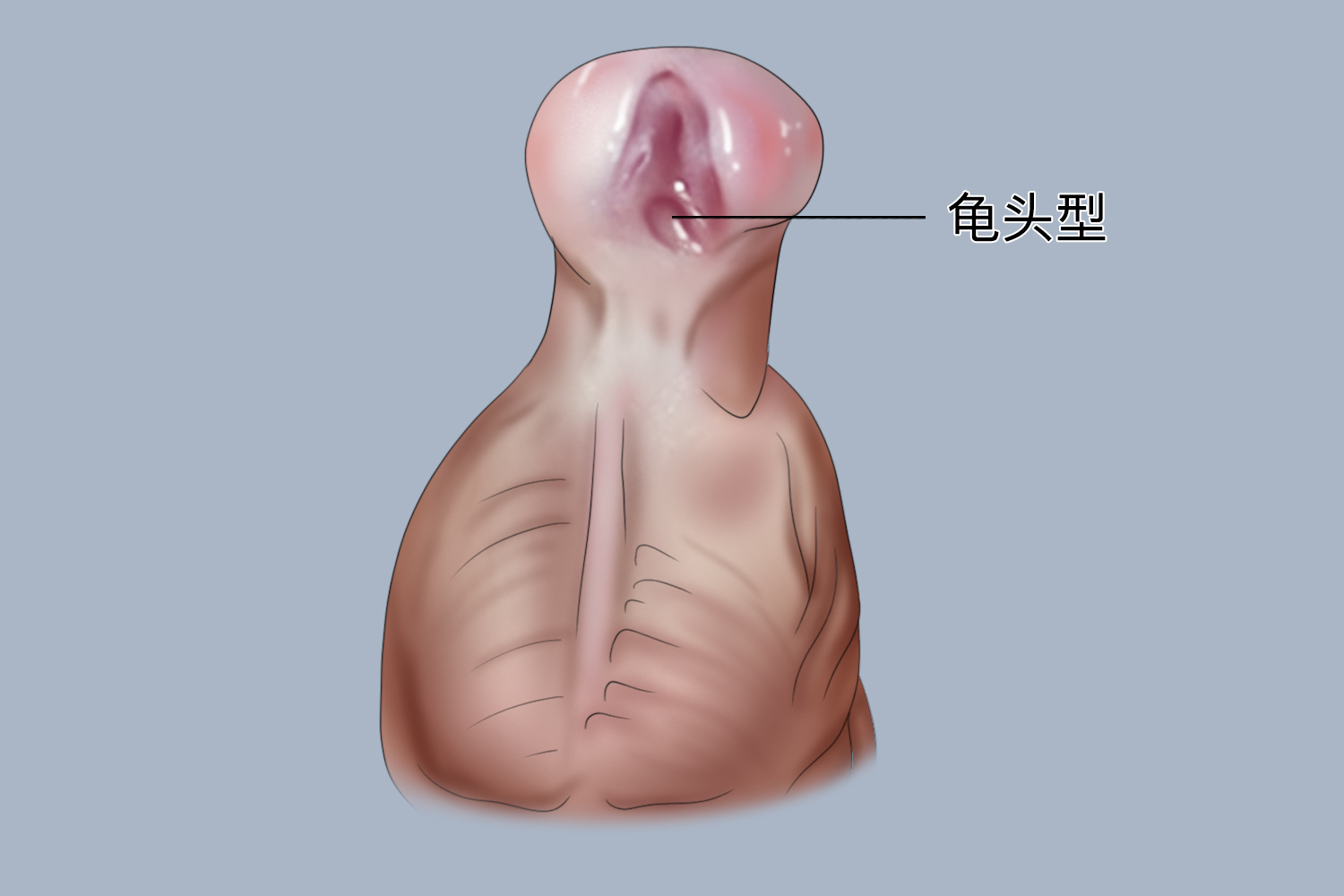 阴茎头型尿道下裂图
